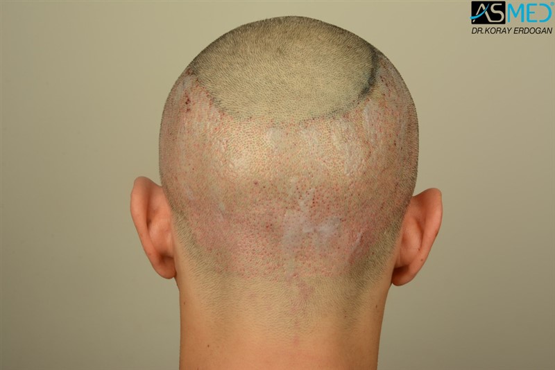 NORWOOD2 2203-grafts-FUE 25