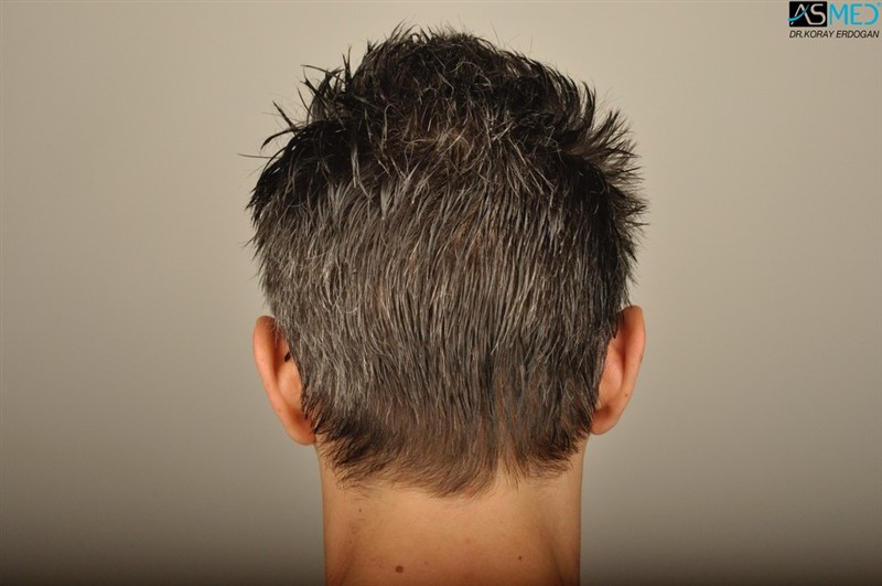 NORWOOD2 2203-grafts-FUE 26