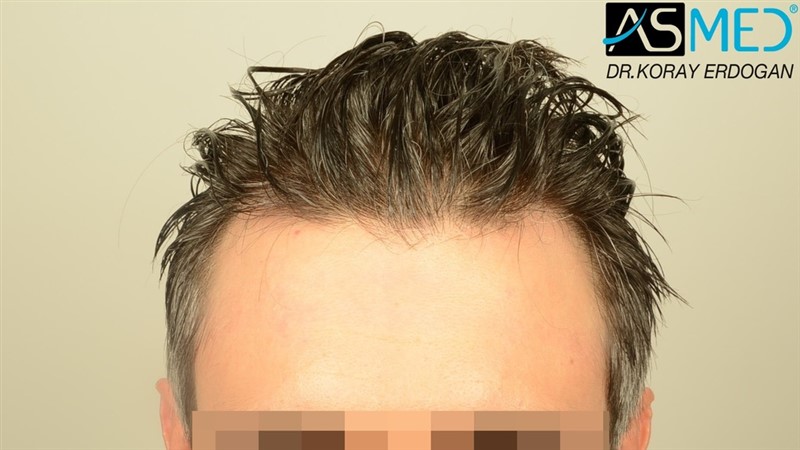NORWOOD2 2203-grafts-FUE 3