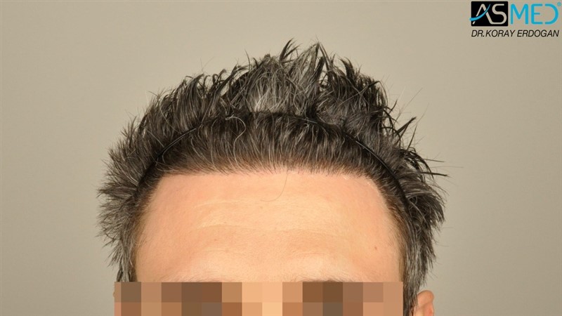 NORWOOD2 2203-grafts-FUE 5