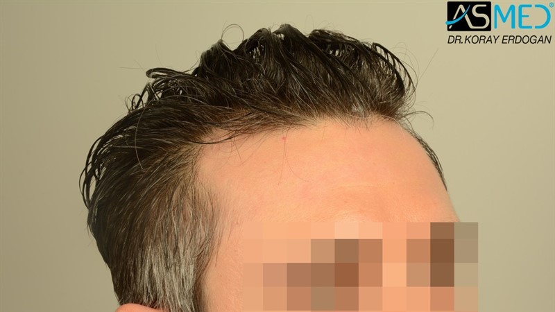 NORWOOD2 2203-grafts-FUE 9