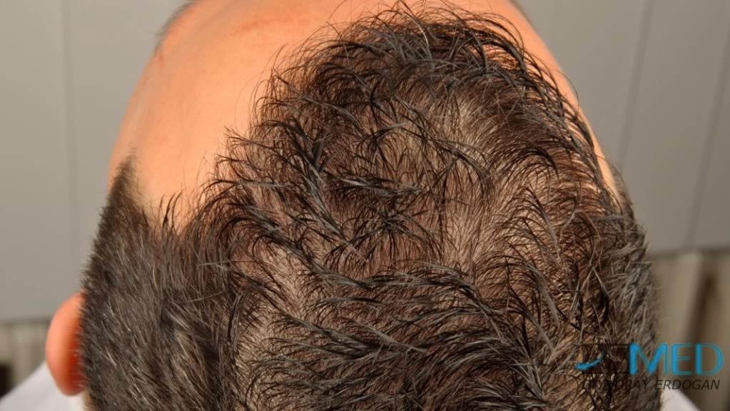 NORWOOD2 2223-grafts-FUE 06603034