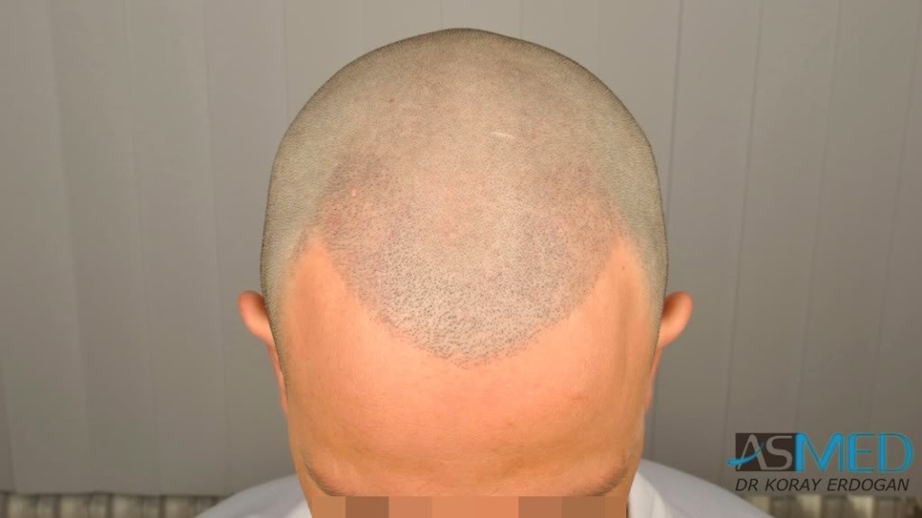 NORWOOD2 2223-grafts-FUE 0deaf513