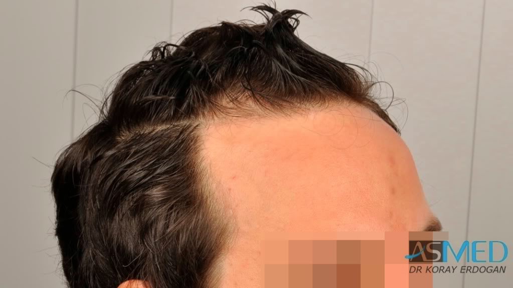 NORWOOD2 2223-grafts-FUE 0f83edcf