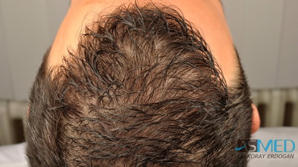 NORWOOD2 2223-grafts-FUE 21c1da17