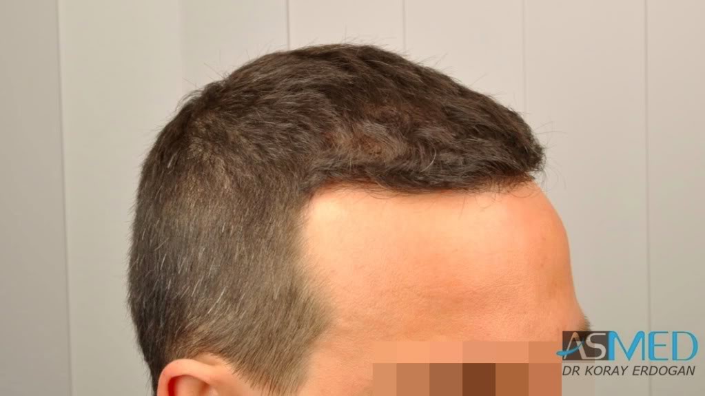 NORWOOD2 2223-grafts-FUE 2274709b