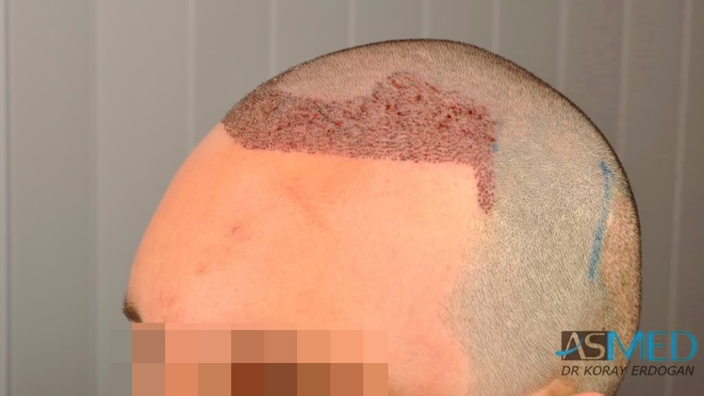 NORWOOD2 2223-grafts-FUE 23cdac04