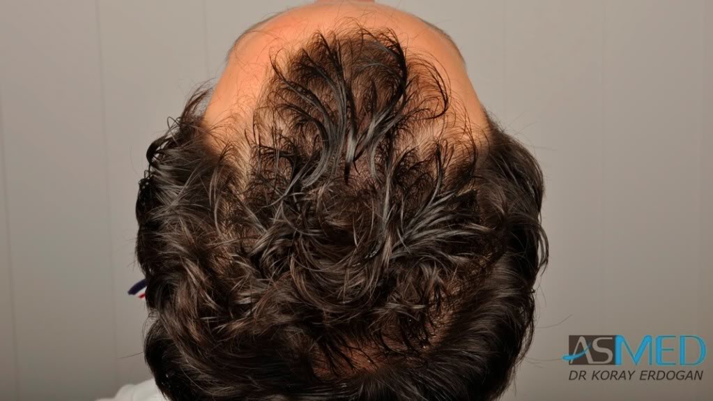 NORWOOD2 2223-grafts-FUE 2a4817dc