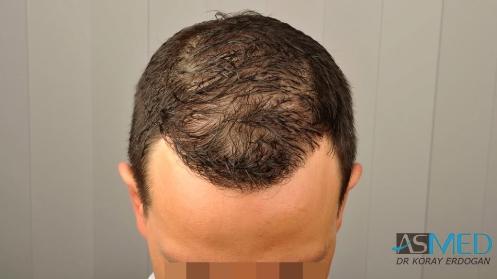 NORWOOD2 2223-grafts-FUE 3b13c04c