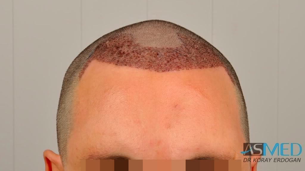 NORWOOD2 2223-grafts-FUE 3e57539a