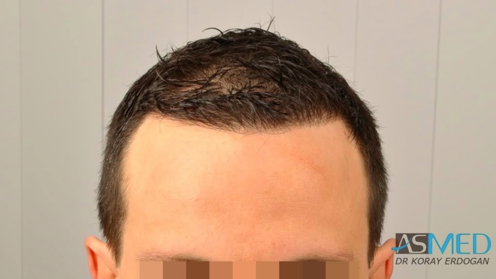NORWOOD2 2223-grafts-FUE 4f59f4c6