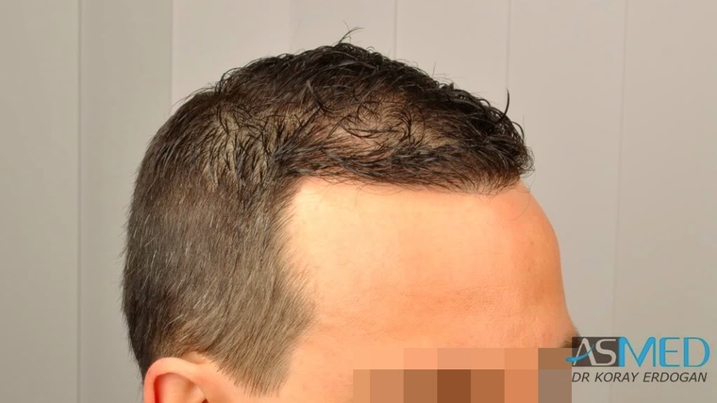 NORWOOD2 2223-grafts-FUE 5274def8