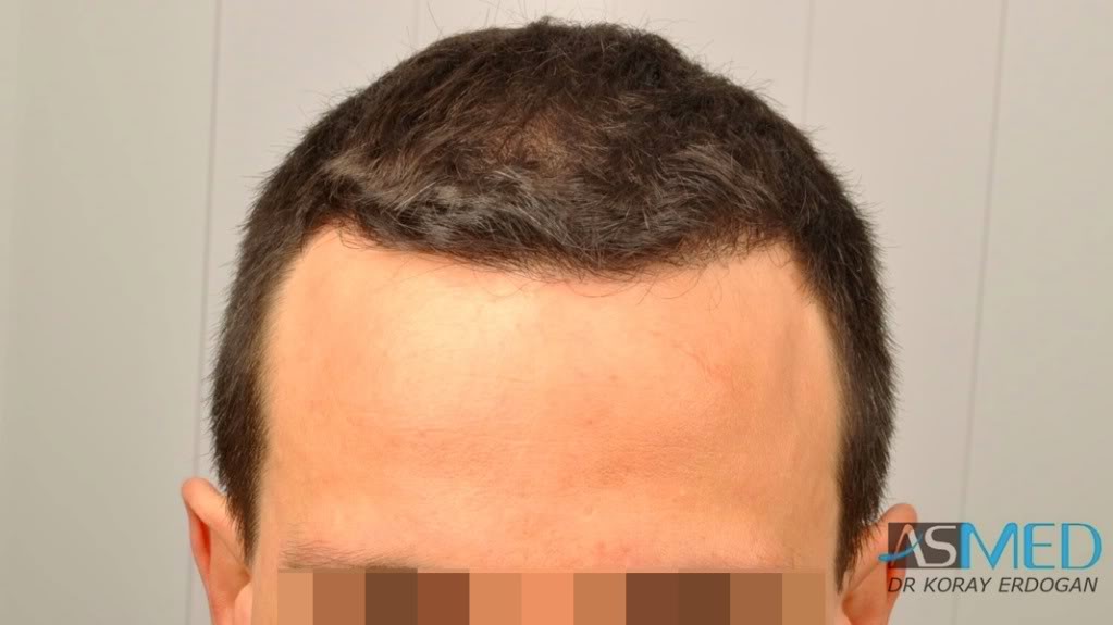 NORWOOD2 2223-grafts-FUE 5452db04