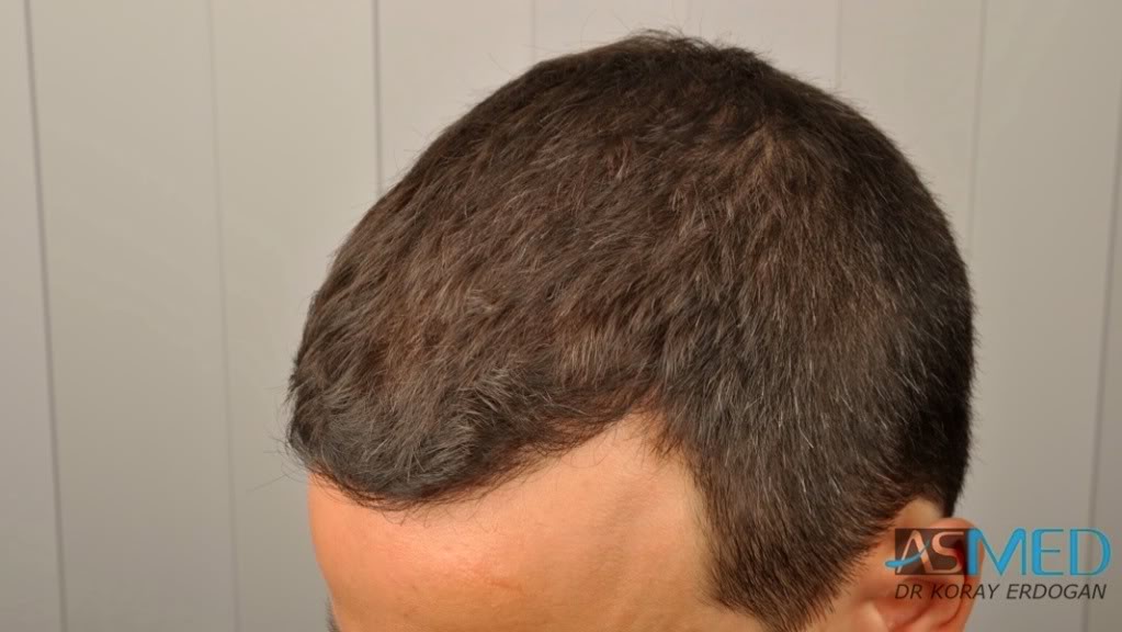 NORWOOD2 2223-grafts-FUE 5a395f77