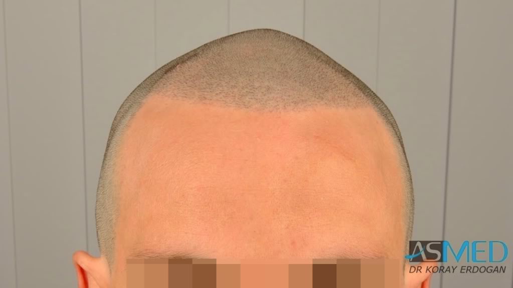 NORWOOD2 2223-grafts-FUE 5bd1c1de