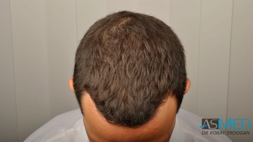 NORWOOD2 2223-grafts-FUE 775c209f