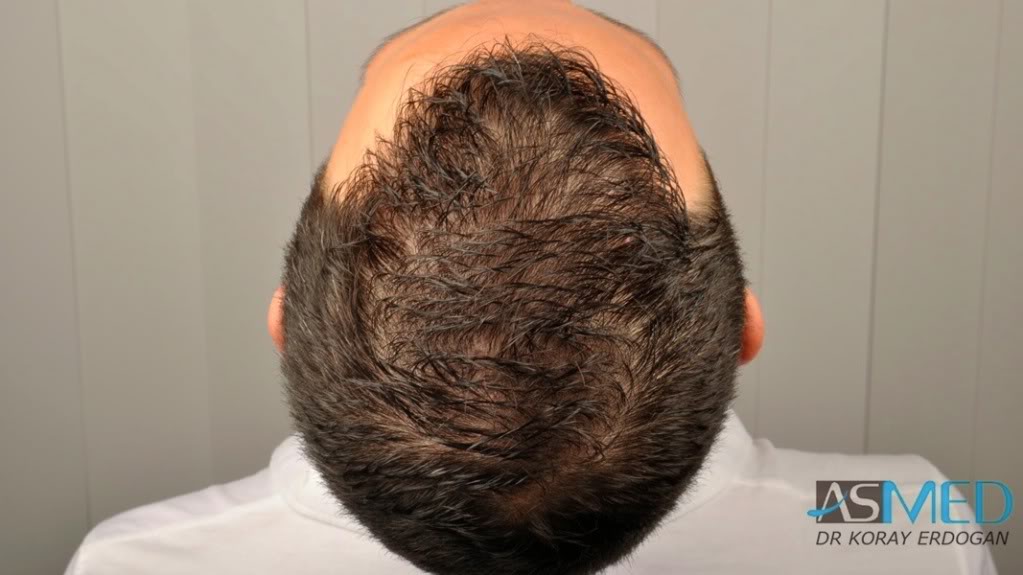 NORWOOD2 2223-grafts-FUE 98991c0c