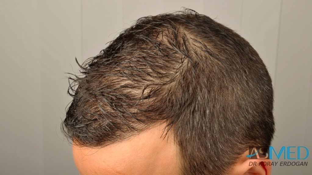 NORWOOD2 2223-grafts-FUE b8e353ad