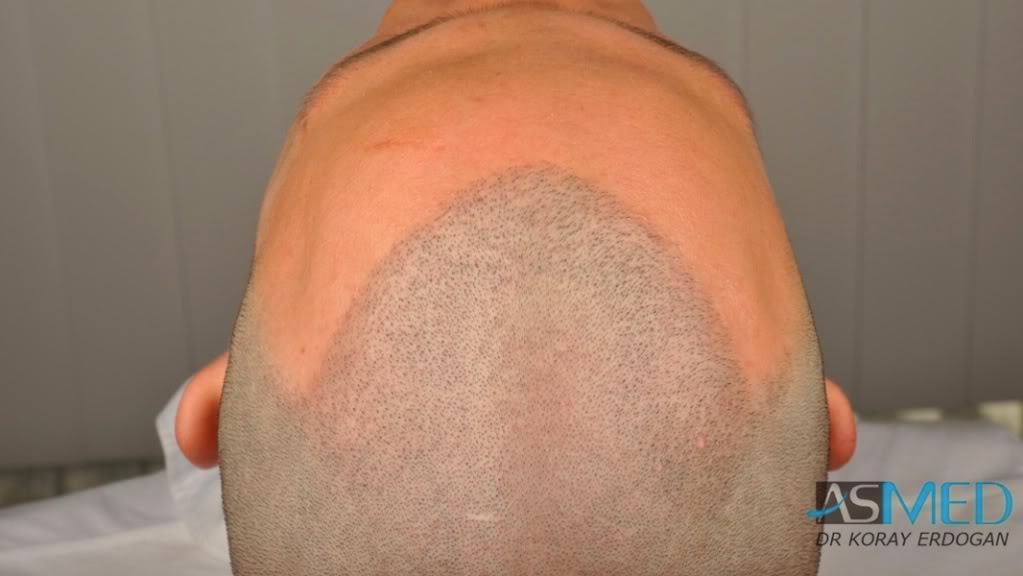 NORWOOD2 2223-grafts-FUE c5fdde4f