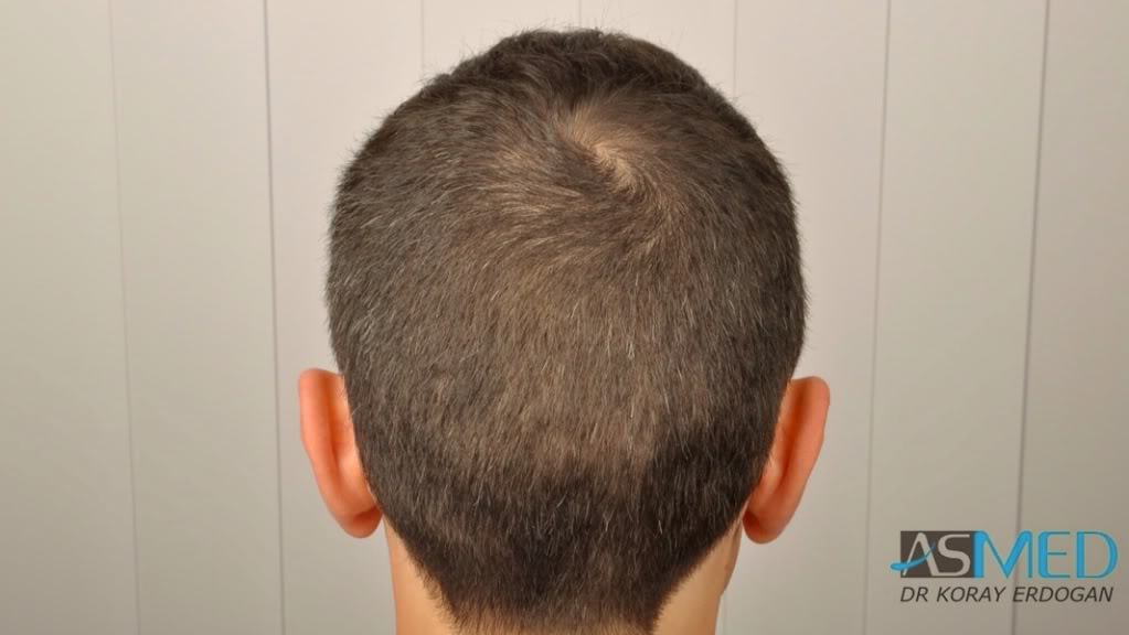 NORWOOD2 2223-grafts-FUE fa3634c8