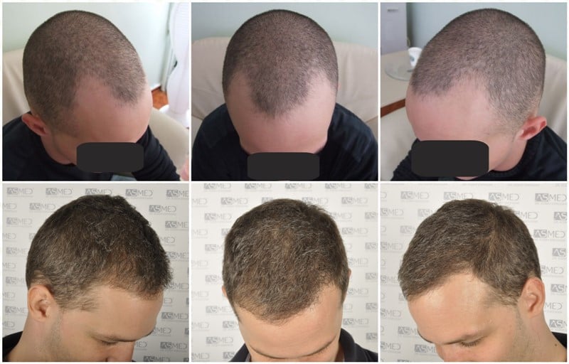 2300-grafts-FUE gallery