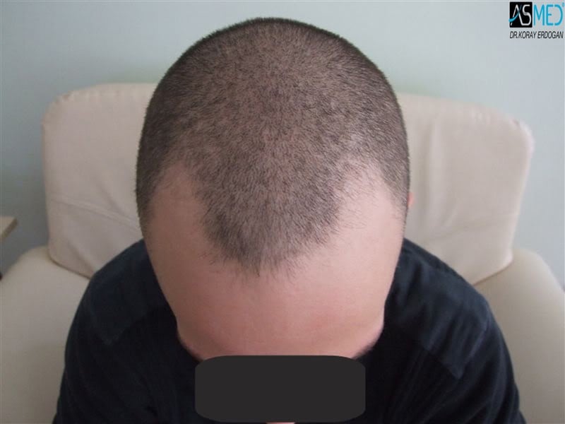NORWOOD2 2300-grafts-FUE V2_tn_PreSurgery2aaa