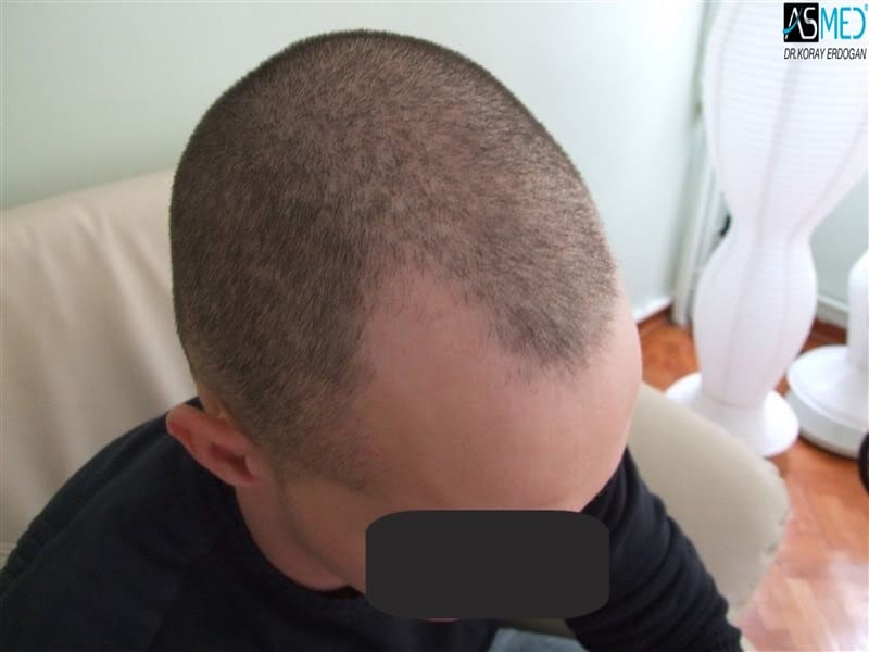 NORWOOD2 2300-grafts-FUE V2_tn_PreSurgery3aaa