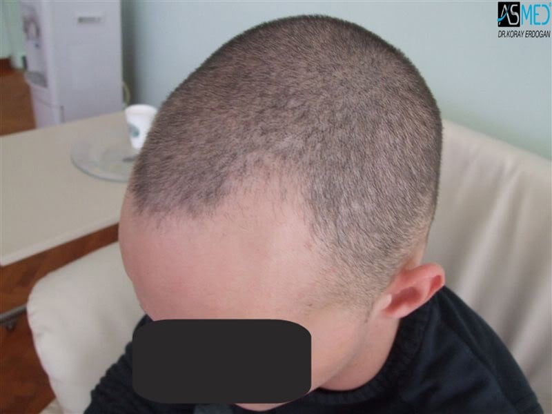 NORWOOD2 2300-grafts-FUE V2_tn_PreSurgery4aaa