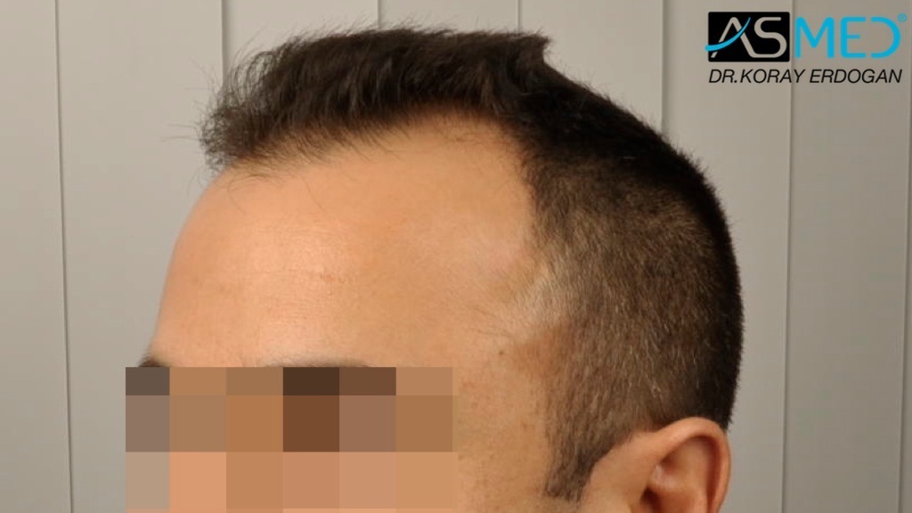 NORWOOD2 2400-grafts-FUE file_zps0059d71b
