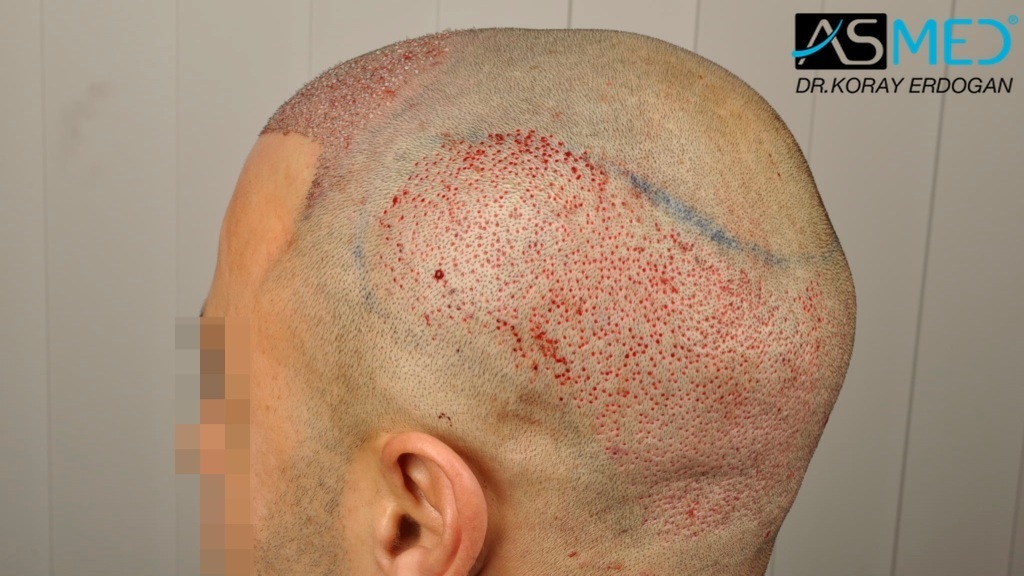 NORWOOD2 2400-grafts-FUE file_zps0499703b