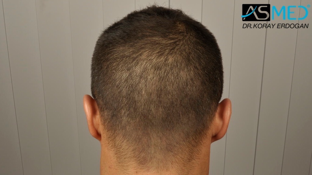 NORWOOD2 2400-grafts-FUE file_zps0926d840