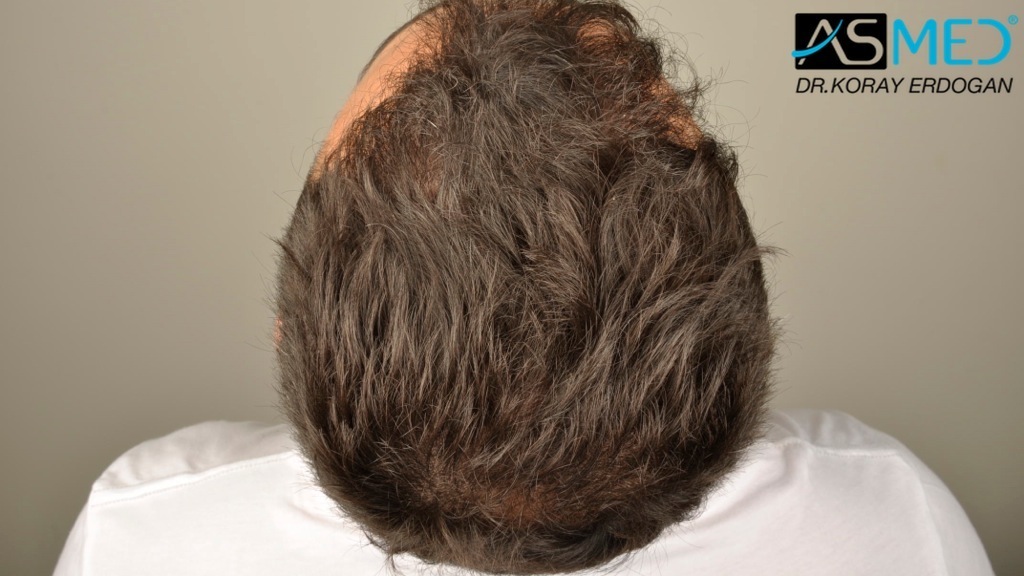 NORWOOD2 2400-grafts-FUE file_zps1062342d