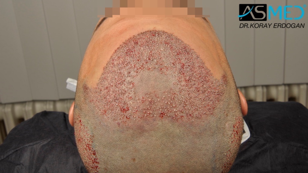 NORWOOD2 2400-grafts-FUE file_zps13833631