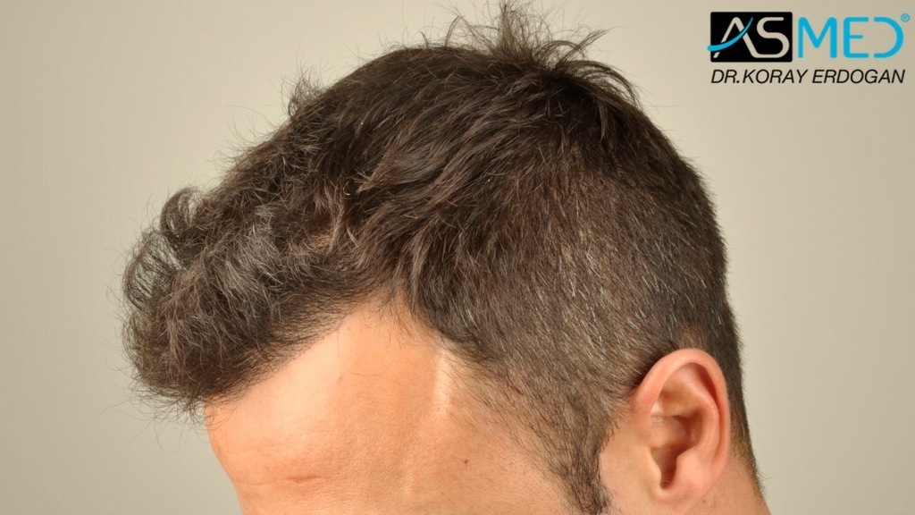 NORWOOD2 2400-grafts-FUE file_zps236b5a87