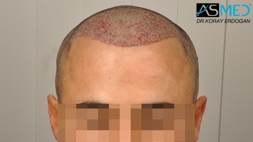 NORWOOD2 2400-grafts-FUE file_zps4a43fcc3