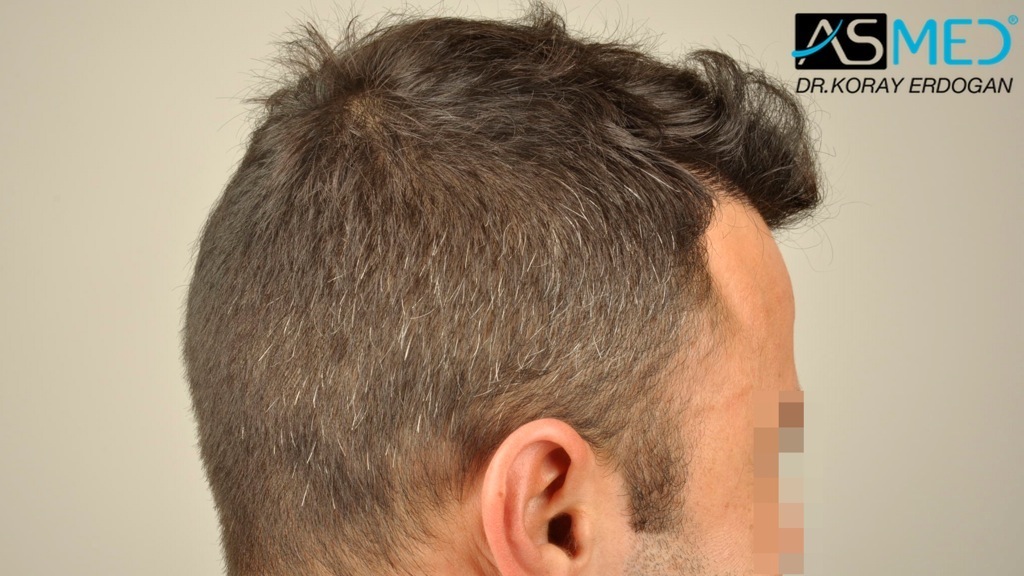 NORWOOD2 2400-grafts-FUE file_zps7470c5a2