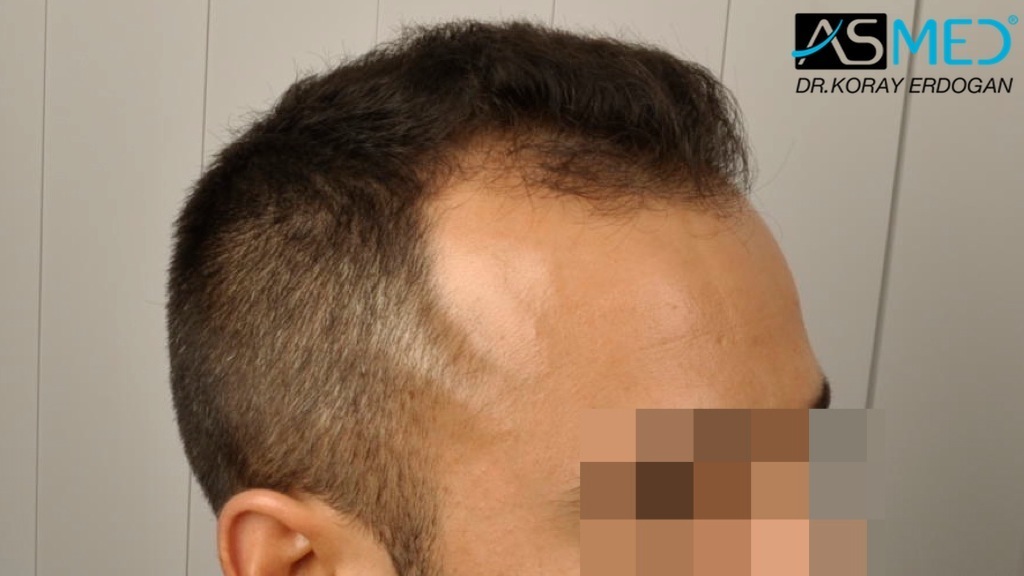 NORWOOD2 2400-grafts-FUE file_zps81268fd1