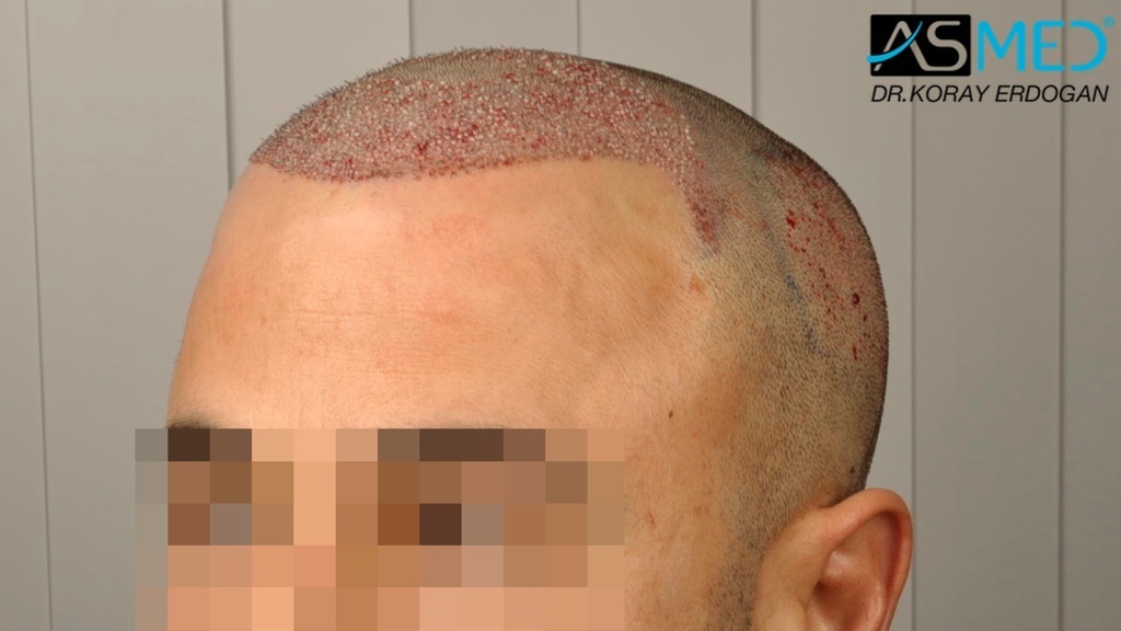 NORWOOD2 2400-grafts-FUE file_zps8f666e0e