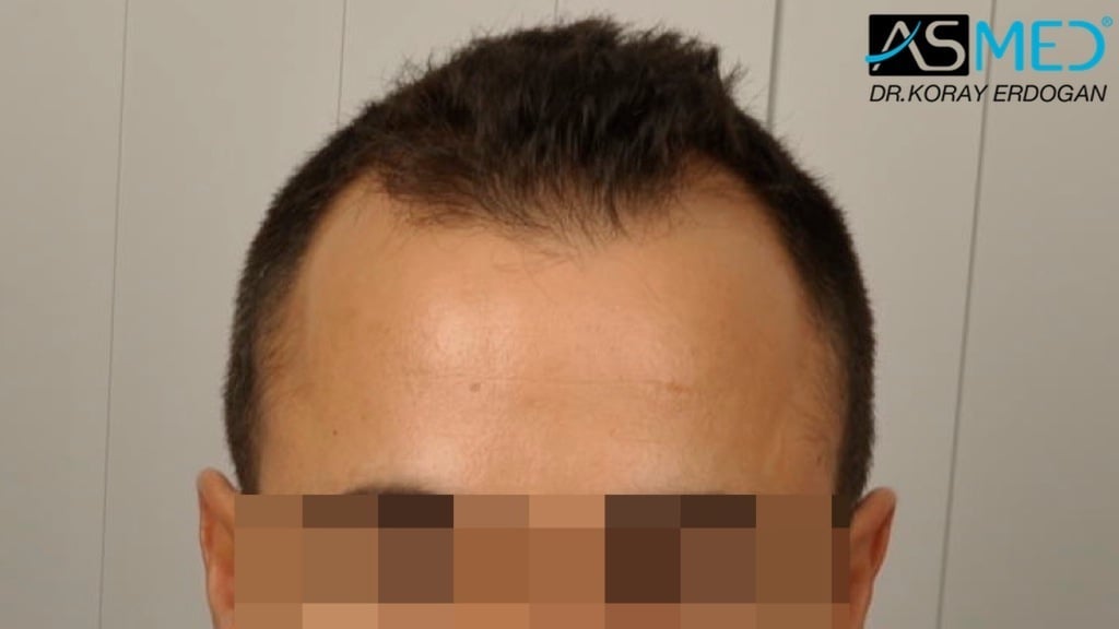 2400-grafts-FUE