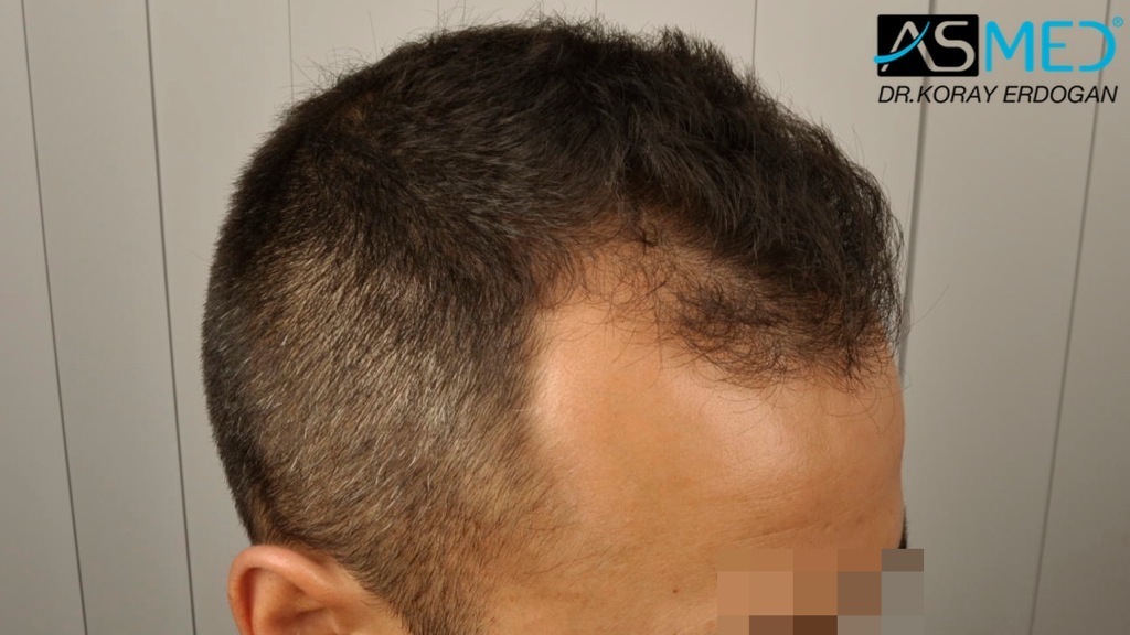 NORWOOD2 2400-grafts-FUE file_zpsa4a67b9f