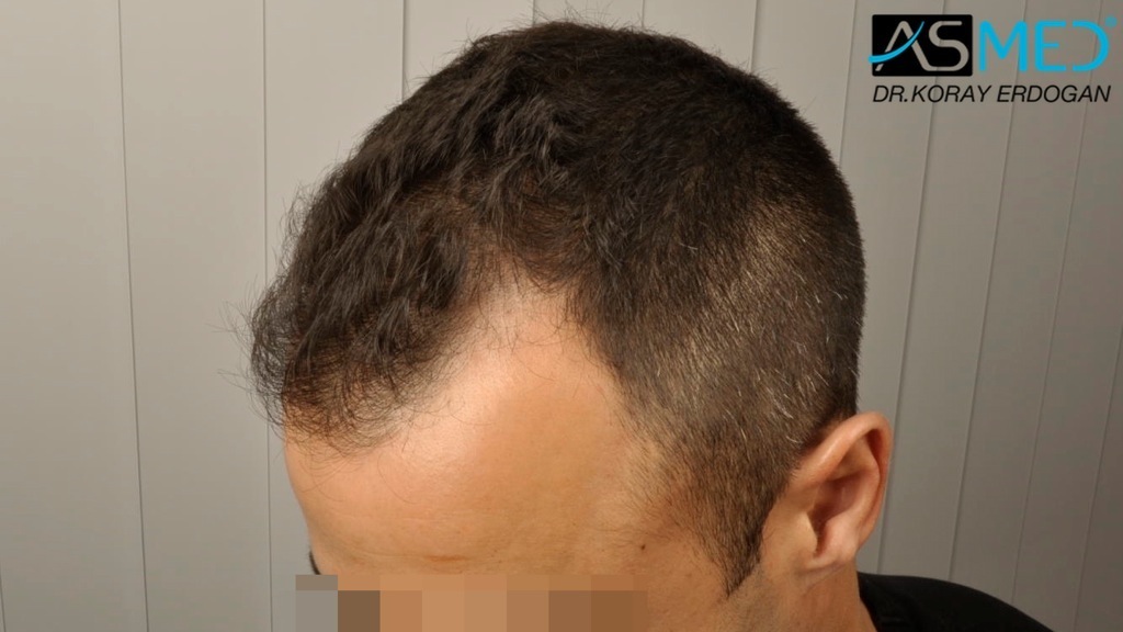 NORWOOD2 2400-grafts-FUE file_zpsa800fda2