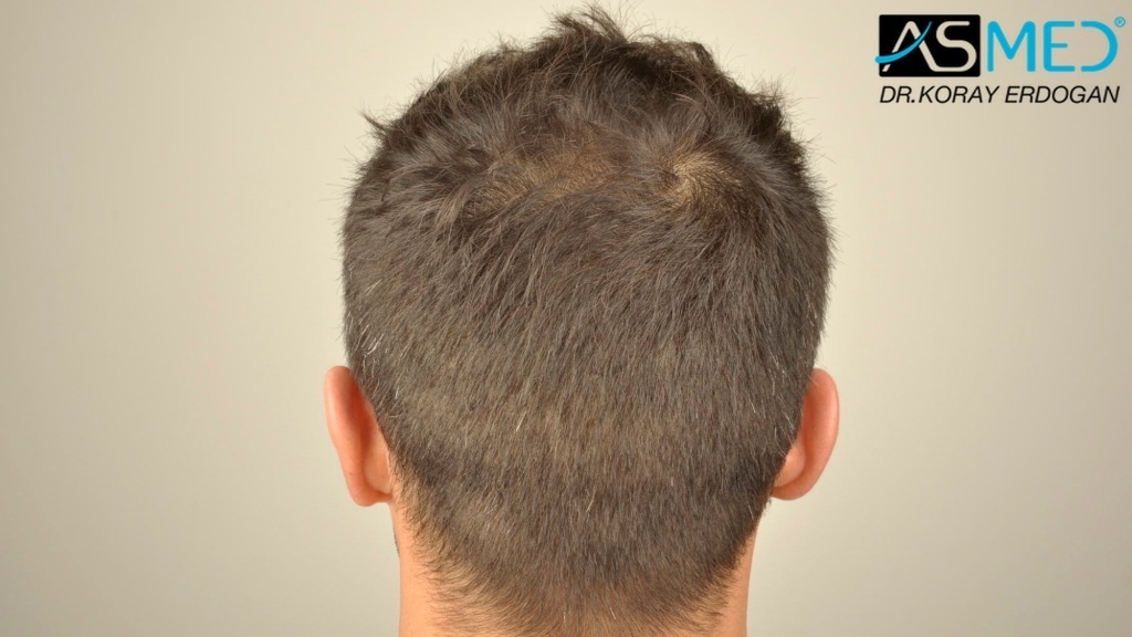 NORWOOD2 2400-grafts-FUE file_zpsb0455675