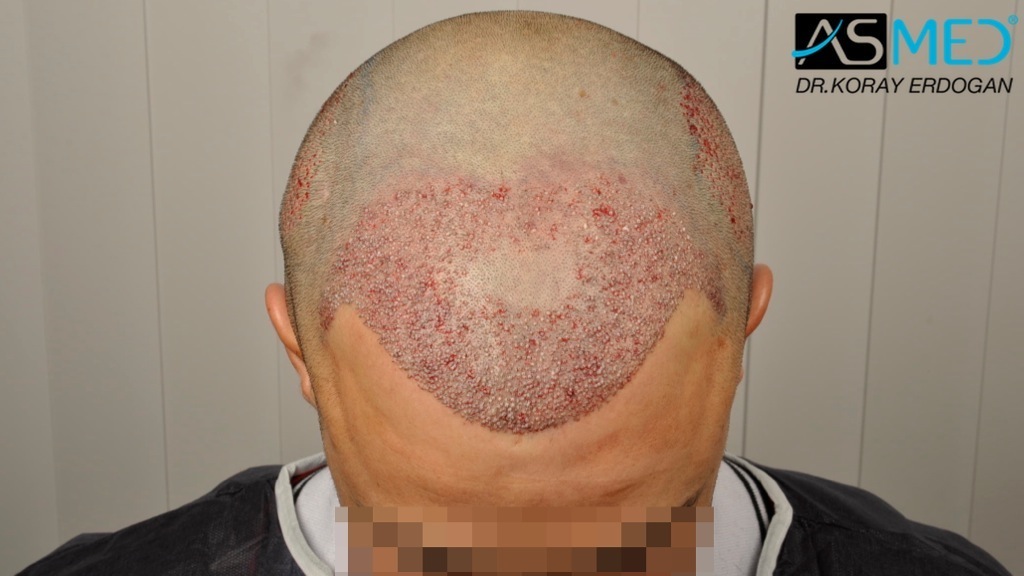 NORWOOD2 2400-grafts-FUE file_zpsce32d56f