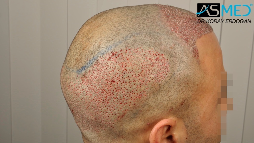 NORWOOD2 2400-grafts-FUE file_zpsd3f91abc