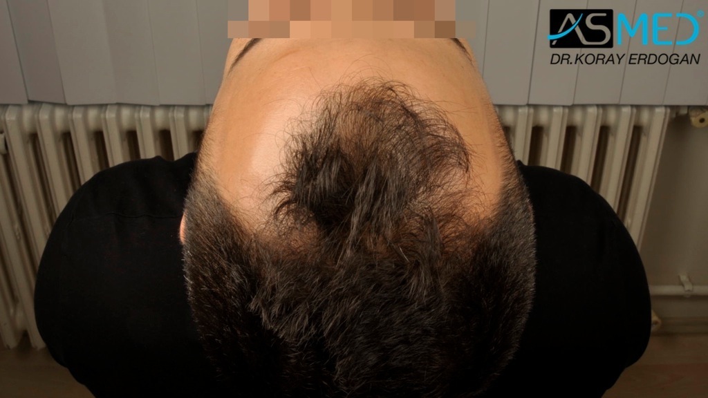 NORWOOD2 2400-grafts-FUE file_zpsd88034a9