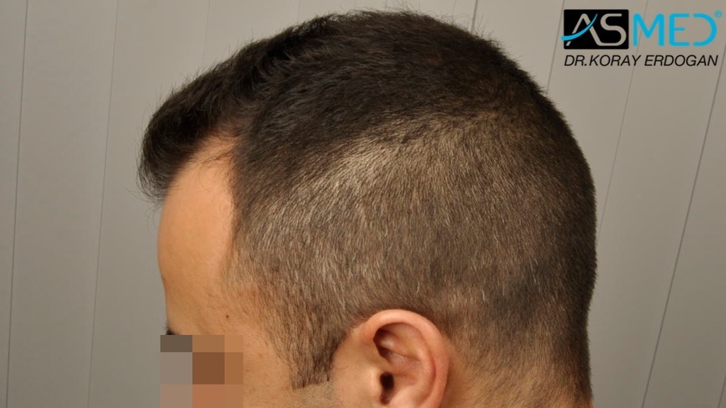 NORWOOD2 2400-grafts-FUE file_zpsdb30e10a
