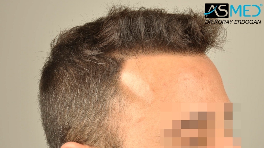 NORWOOD2 2400-grafts-FUE file_zpsdba15124