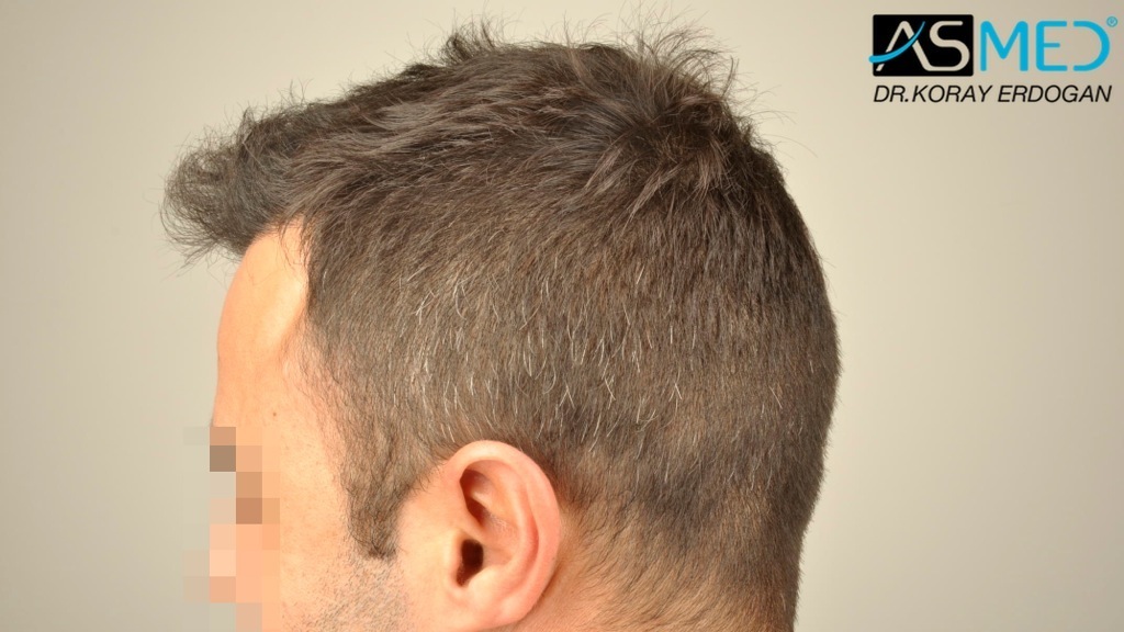 NORWOOD2 2400-grafts-FUE file_zpsde23ed15
