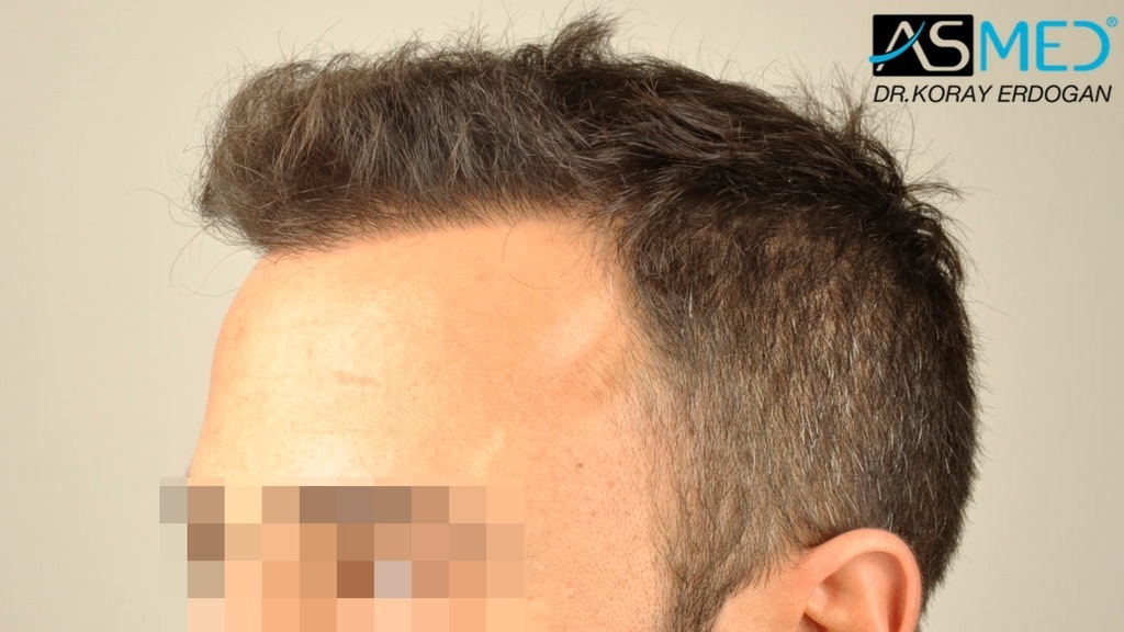 NORWOOD2 2400-grafts-FUE file_zpse714e597