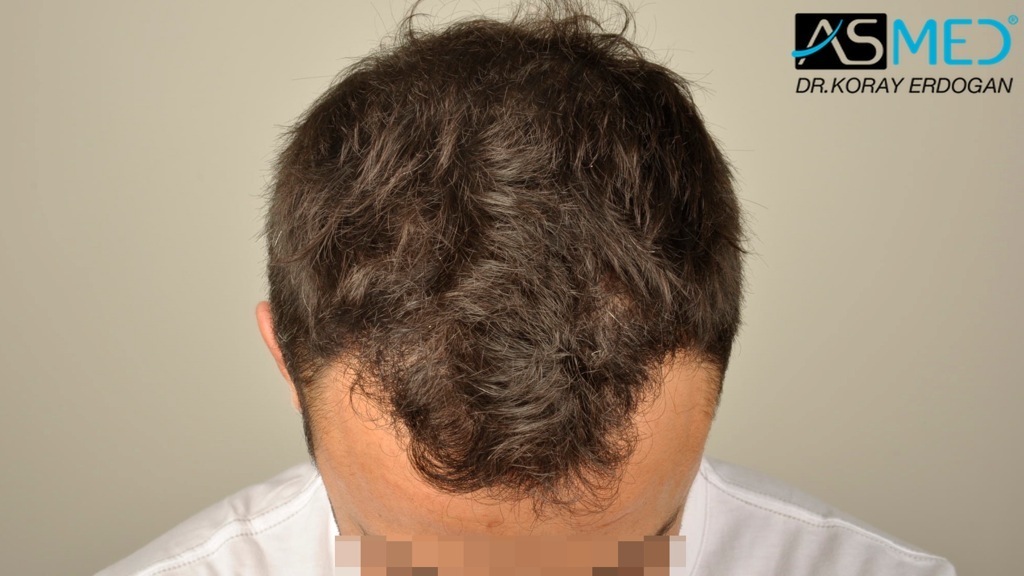 NORWOOD2 2400-grafts-FUE file_zpsf47bf963